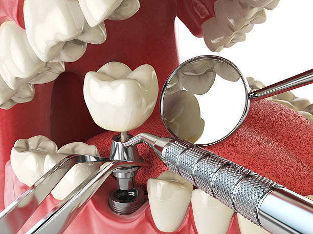 Best Broken or Cracked Tooth Emergency Dentist in Chevy Chase Village, MD